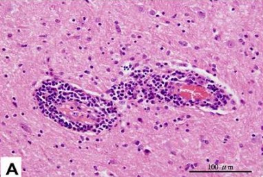 非化膿性腦膜腦炎之血管圍管現象(出處：Lee, 2014. Pathological diagnosis on major pig diseases in Taiwan.)。