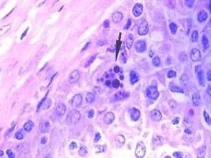 感染豬環狀病毒(PCV-2)之組織病理變化，淋巴結中巨噬細胞可見嗜鹼性質內包涵體(箭頭)。
